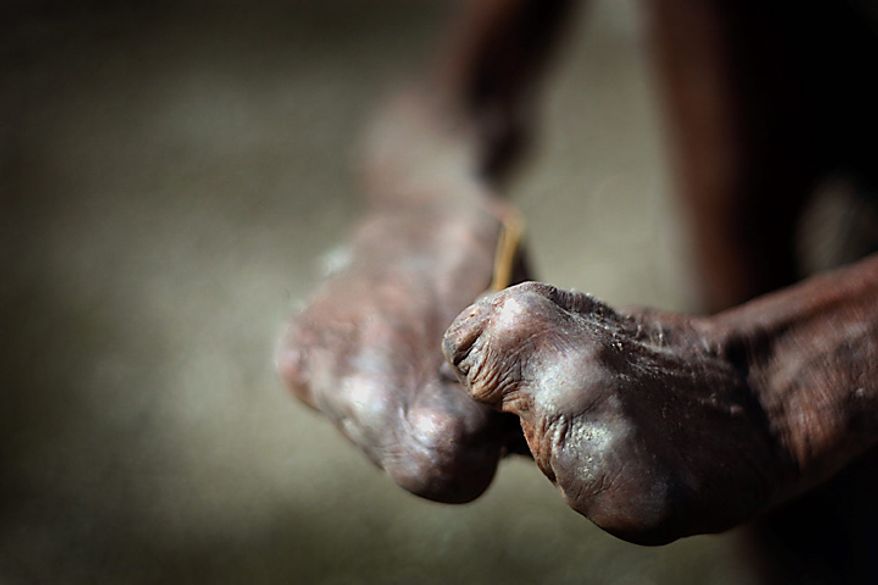 In this photo taken on Thursday, July 8, 2010, the hands of former leprosy patient Adelino Quelo, 68, are seen as he crouches outside his hut in Malelat, West Oe-cusse, overlooking the East Nusa Tengara province of Indonesia. His fingers, toes and parts of his hands and feet are missing. Only stubby knobs remain, keeping him from standing, gripping and bathing himself. East Timor is one of just two places worldwide where leprosy is still widespread, and the country has now declared war on the age-old scourge. (AP Photo/Wong Maye-E)