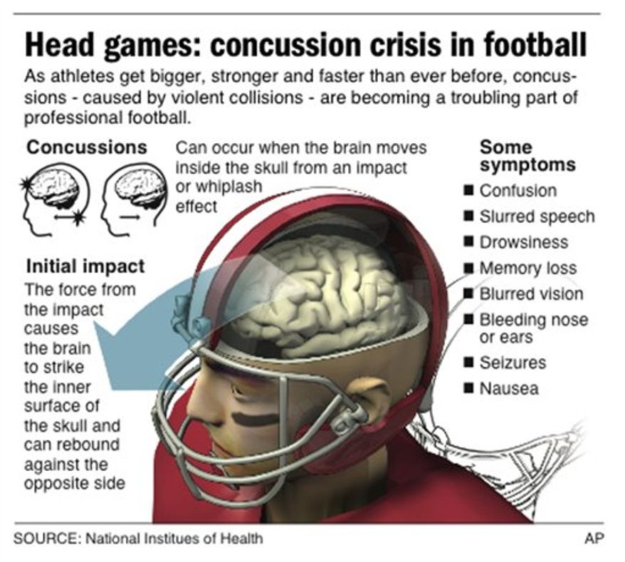 Graphic describes what happens to the brain of a football player to cause a concussion