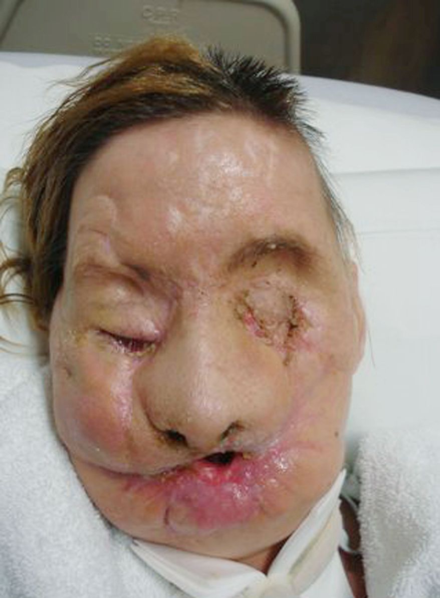 brigham and women's hospital via associated press
Charla Nash of Stamford, Conn., who was mauled two years ago by a neighbor's pet chimpanzee, is recovering in a nursing home from a face transplant performed in May at Brigham and Women's Hospital in Boston. Before and after photos above show the extent of her injuries and how she looks now. An undated family photo below shows Ms. Nash before the chimpanzee's attack. "I will now be able to do things I once took for granted," she said in the statement.
