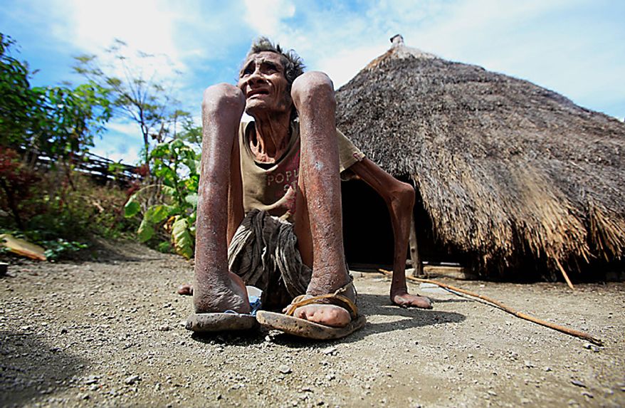In this photo taken on Thursday July 8, 2010, former leprosy patient Adelino Quelo, 68, crouches outside his hut in Malelat, West Oe-cusse, overlooking the East Nusa Tengara province of Indonesia. His fingers, toes and parts of his hands and feet are missing. Only stubby knobs remain, keeping him from standing, gripping and bathing himself. East Timor is one of just two places worldwide where leprosy is still widespread, and the country has now declared war on the age-old scourge. (AP Photo/Wong Maye-E)