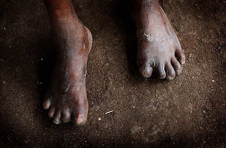 This photo taken on Wednesday July 7, 2010 shows the feet of Luis Siqueira Aforn, 65, who's toes were chewed by rats while he was sleeping on the ground in Hauana, East Timor, south of Oe-cusse town. The loss of sensation led him to be oblivious to the nibbling of the rodents. East Timor is one of just two places worldwide where leprosy is still widespread, and the country has now declared war on the age-old scourge. (AP Photo/Wong Maye-E)