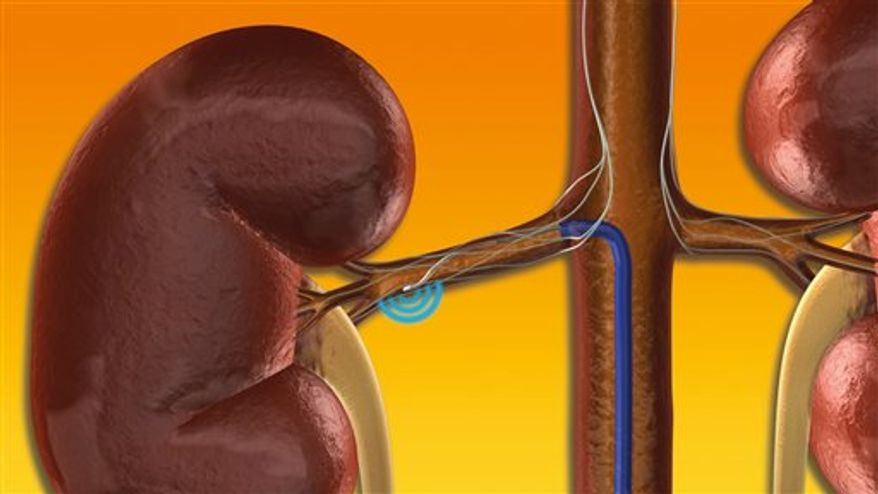 This illustration provided by Ardian's Symplicity Catheter System shows the Symplicity Catheter System, which delivers low-power RF energy to deactivate the renal sympathetic nerves. A study reported Wednesday, Nov. 17, 2010 at the American Heart Association conference in Chicago says that some people who couldn't get their blood pressure under control despite taking a fistful of pills every day found relief from an experimental treatment that shows promise as a possible permanent fix for the condition. The treatment uses radio waves to zap nerves near the kidneys that fuel high blood pressure. It is done through a tube pushed into a blood vessel in the groin, much like the angioplasty procedures for opening clogged heart arteries. (AP Photo/Ardian's Symplicity Catheter System)