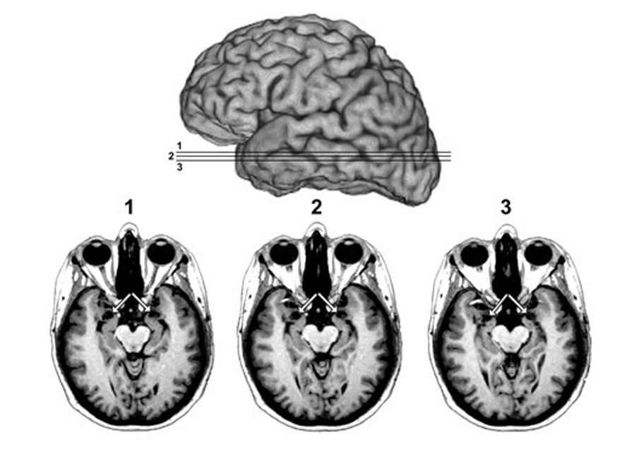 An undated image of a MRI brain scan (AP Photo/University of Iowa Department of Neurology)