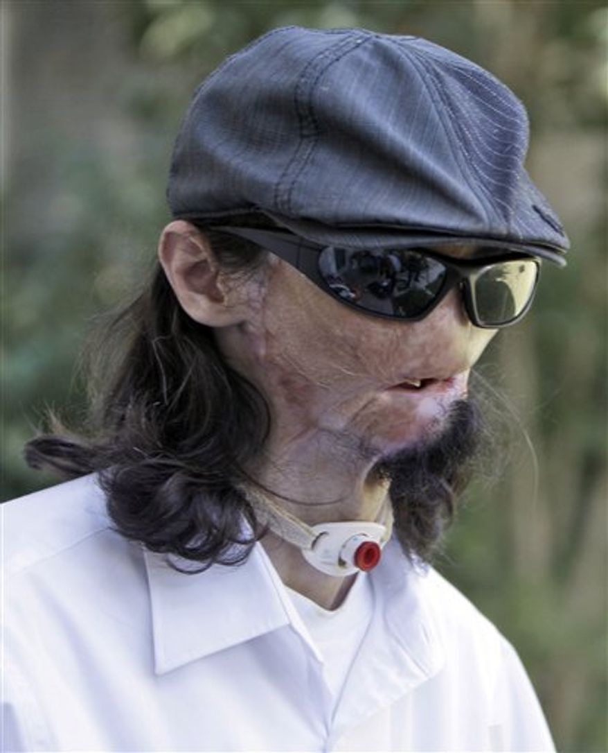 FILE - EDS NOTE GRAPHIC CONTENT - In this Oct. 13, 2010 file photo, Dallas Wiens, 25, describes his injuries during an interview in Fort Worth, Texas. Weins was critically burned in a 2008 high-voltage power line accident and received a full face transplant at Brigham and Women's Hospital in Boston, during the week of March 14, 2011. (AP Photo/LM Otero)