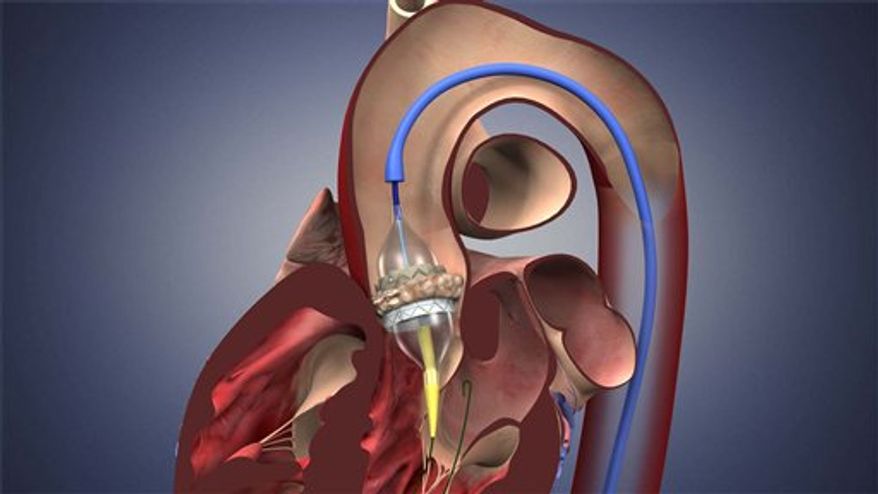 This image provided by Edwards Lifesciences shows a graphic of the Edwards SAPIEN valve. A long-awaited study suggests that many people with bad aortic valves can have them replaced through a tube into an artery instead of open-heart surgery. Edwards Lifesciences Corp. is seeking federal approval for its experimental SAPIEN aortic valve, implanted through an artery. (AP Photo/Edwards Lifesciences) NO SALES