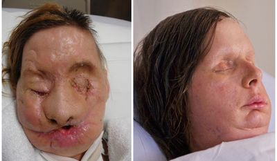 ** FILE ** Undated photos provided Aug. 11, 2011, by Brigham and Women’s Hospital show chimpanzee attack victim Charla Nash after the attack (left) and post-face transplant surgery (right). Nash, 57, was mauled by the chimpanzee in 2009 and received the transplant in May 2011 at Brigham and Women’s Hospital in Massachusetts. (Associated Press/Brigham and Women’s Hospital, Lightchaser Photography)