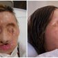 ** FILE ** Undated photos provided Aug. 11, 2011, by Brigham and Women’s Hospital show chimpanzee attack victim Charla Nash after the attack (left) and post-face transplant surgery (right). Nash, 57, was mauled by the chimpanzee in 2009 and received the transplant in May 2011 at Brigham and Women’s Hospital in Massachusetts. (Associated Press/Brigham and Women’s Hospital, Lightchaser Photography)