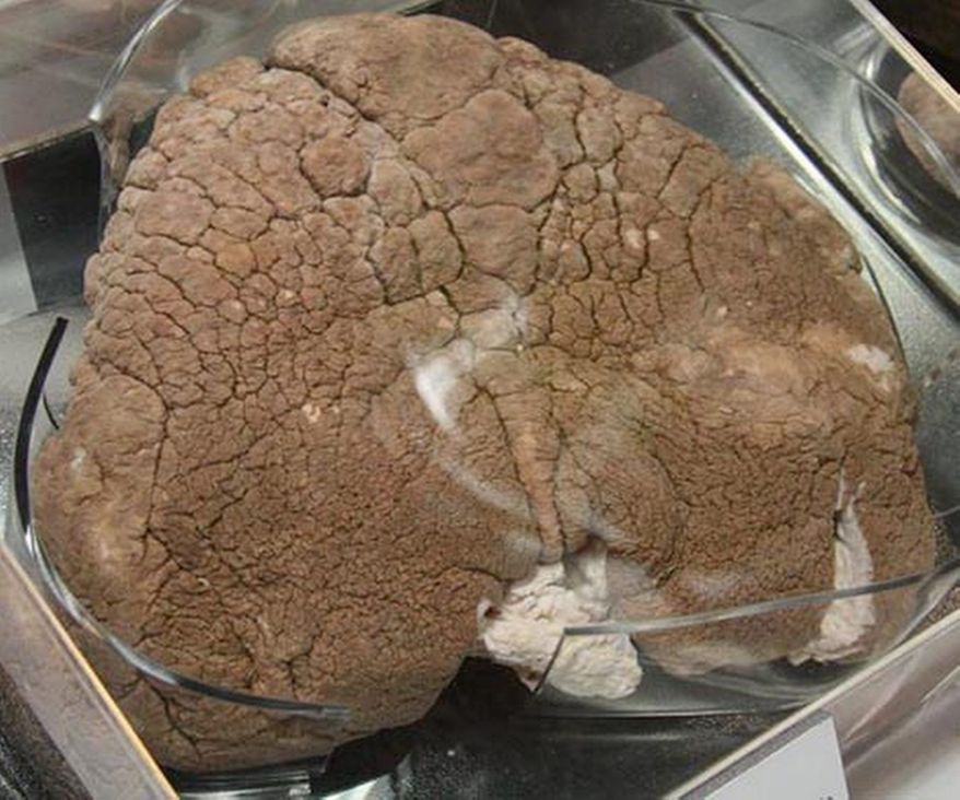 Elephantiasis scrotum from the exhibit "Visibly Human: Health and Disease in the Human Body" at the National Museum of Health and Medicine. (National Museum of Health and Medicine)