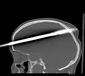 Spear Gun Accident_Lea.jpg
