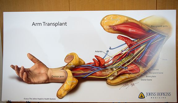A diagram of an arm transplant on display at a press conference to announce the successful completion of the Johns Hopkins Hospital&#x27;s first bilateral arm transplant performed on Iraq war veteran Brendan Marrocco, Baltimore, Md., Tuesday, January 29, 2013. Marrocco lost all four limbs from a bomb outside Baghdad, Iraq. (Andrew Harnik/The Washington Times)