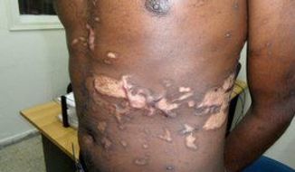 Scars reveal some of the extent of the torture endured by sub-Saharan refugees after becoming ensnared by human traffickers on the Sinai Peninsula. (Physicians for Human Rights-Israel)