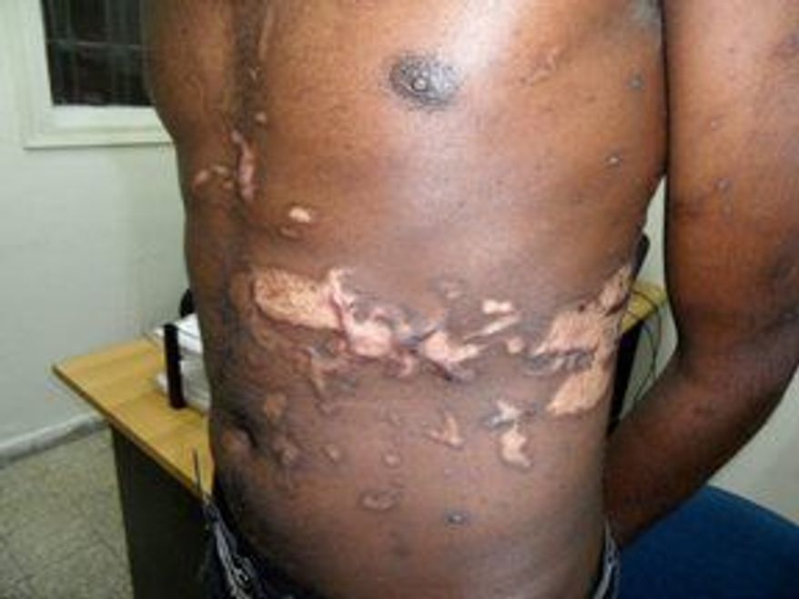 Scars reveal some of the extent of the torture endured by sub-Saharan refugees after becoming ensnared by human traffickers on the Sinai Peninsula. (Physicians for Human Rights-Israel)