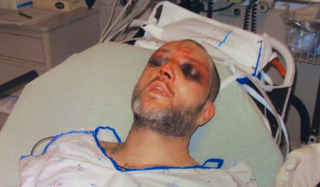 FILE - This file photo provided by the Washington County Hospital shows the bruising on Kenneth Davis' face that he alleges were inflicted by correctional officers at the Roxbury Correctional Institution near Hagerstown, Md., on March 8 and 9, 2008.  Josh Hummer, a former state correctional officer, is the first among 15 indicted officers to go to trial on federal charges stemming from Davis' beating. Jury selection for Hummer's trial begins Thursday, Jan. 23, 2014 in Baltimore. Twelve have pleaded out, but Hummer denies allegations that he failed to stop the assault, ignored the inmate's serious injuries and obstructed the investigation. (AP Photo/Washington County Hospital, File)