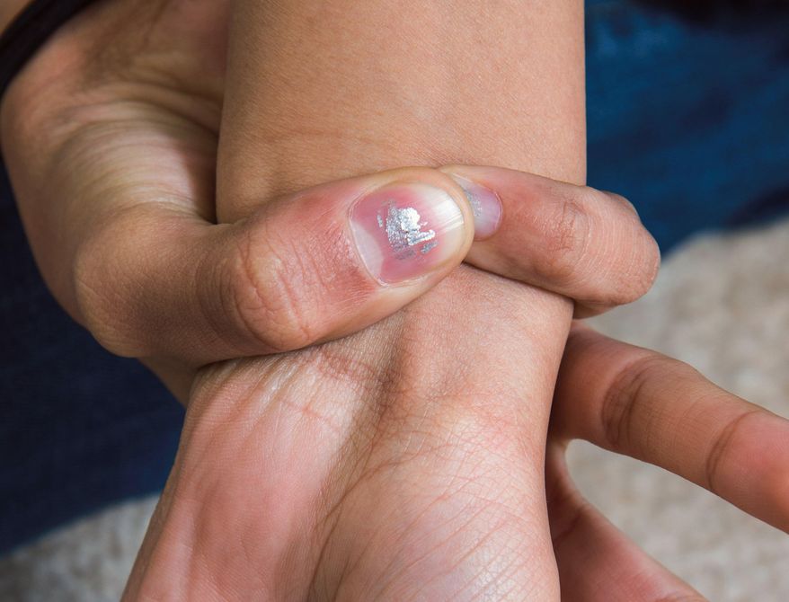 In this Feb. 6, 2014 photo, Kat Sullivan, 13, who has Marfan Syndrome, grabs hold of her wrist at her home in Champaign, Ill .Marfan is a tissue disorder that affects the long bones of the body, which can lead to the tall, thin build, long arms, legs, fingers and toes and flexible joints. (AP Photo/The News-Gazette, Robin Scholz) MANDATORY CREDIT