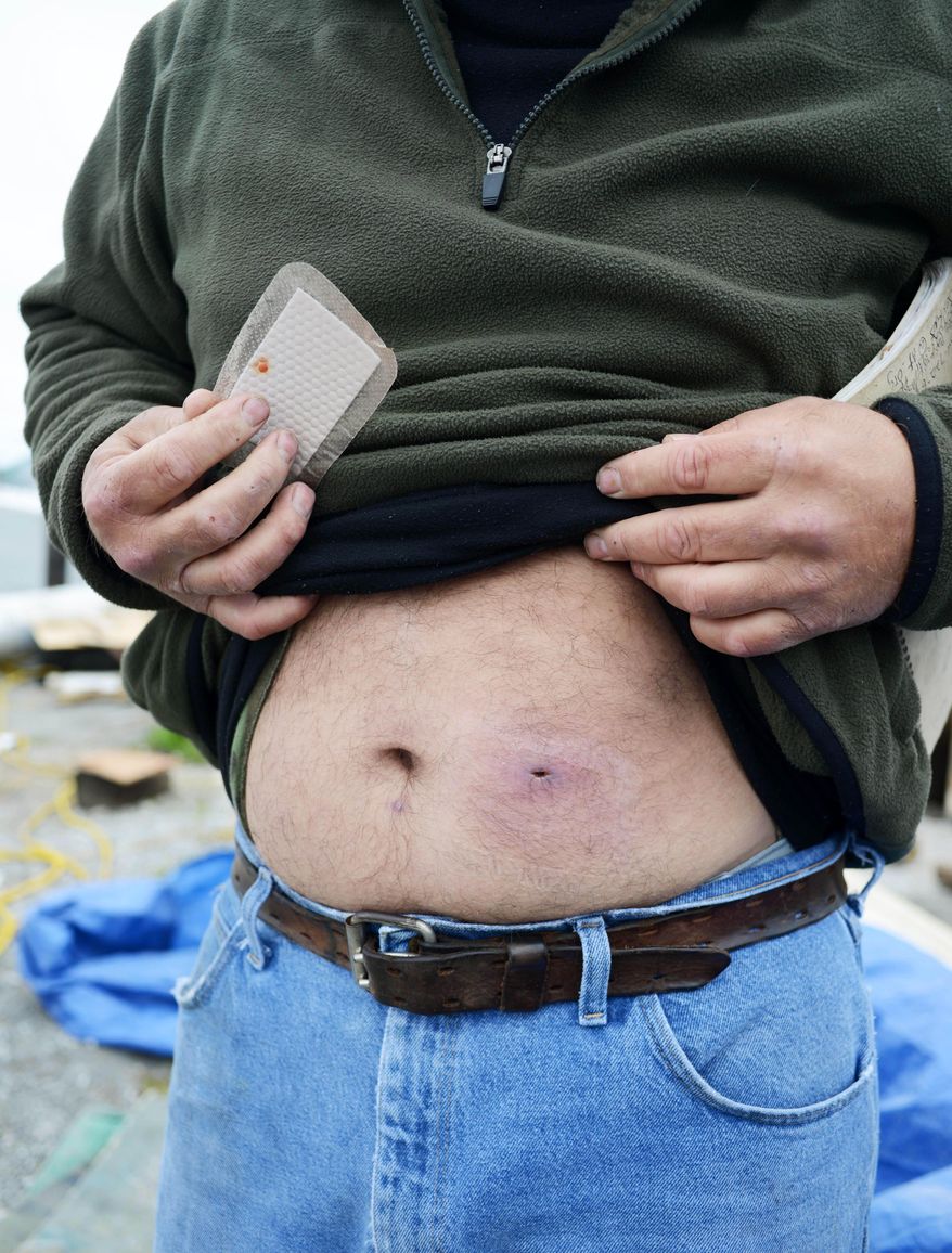 Bert Ducote shows the place where he had a boil lanced and another boil underneath his belly button that he claims are the result of being in direct contact with crude oil while performing cleanup work during the Deepwater Horizon oil spill. Photo taken at the Lake Catherine Marina in New Orleans, Friday, March 7, 2014. (AP Photo/Andrea Mabry)