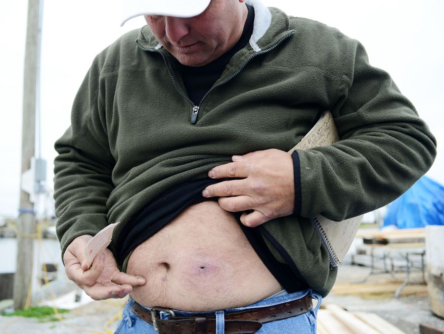 CORRECTS SPELLING - Bert Ducote shows the place where he had a boil lanced and another boil underneath his belly button that he claims are the result of being in direct contact with crude oil while performing cleanup work during the Deepwater Horizon oil spill. Photo taken at the Lake Catherine Marina in New Orleans, Friday, March 7, 2014. (AP Photo/Andrea Mabry)