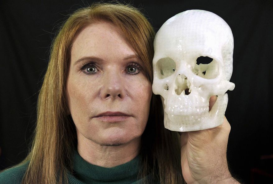 In this photo taken Jan. 13, 2015, Pamela Shavaun Scott holds a 3D printer model of her skull after her brain tumor was removed from behind her eye, in Morro Bay, Calif. Doctor after doctor said removing the tumor causing Pamela Shavaun Scott's unrelenting headaches would require cutting open the top of her skull and pushing aside her brain. Then one doctor offered a startling shortcut _ operating through her eyelid to get into the hard-to-reach center of the head. A big benefit: "We have to saw off much less of your head." (AP Photo/Phil Klein)