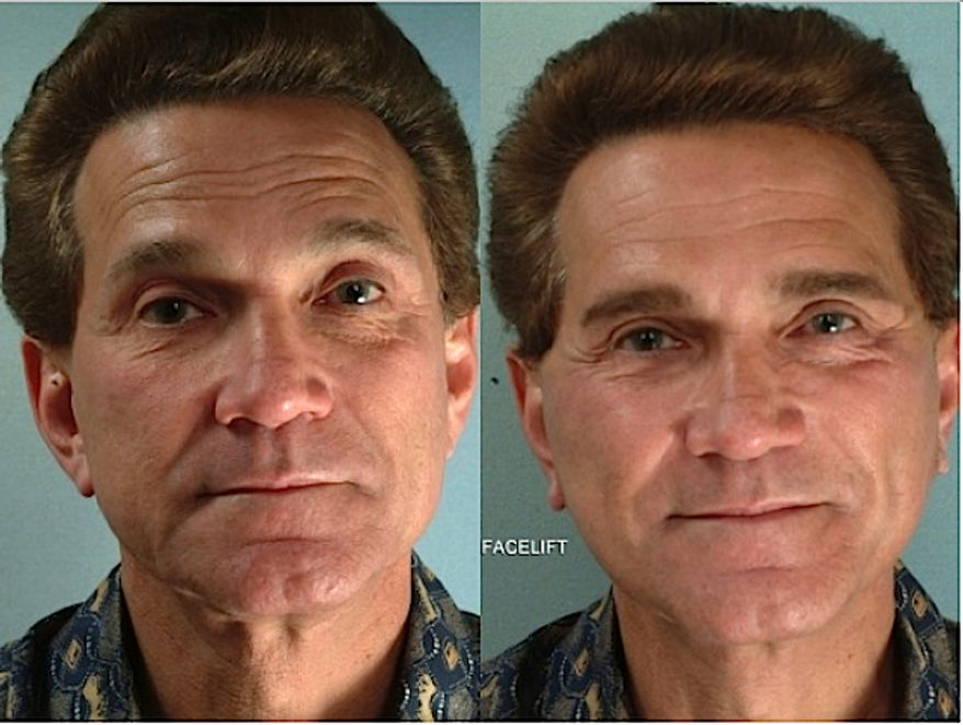A before and after facelift on a 67-year-old man. (ASAPS photo)
