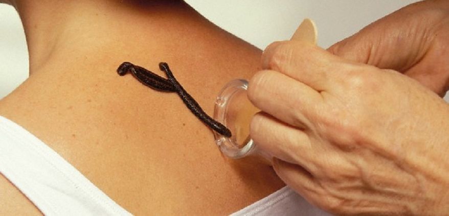 Leech Therapy – Leeches have been applied to people’s skin for various health benefits throughout history, often with little to no basis in scientific evidence. However, the practice continues to this day with some celebrities, including Demi Moore, touting it as an effective anti-aging beauty treatment.
