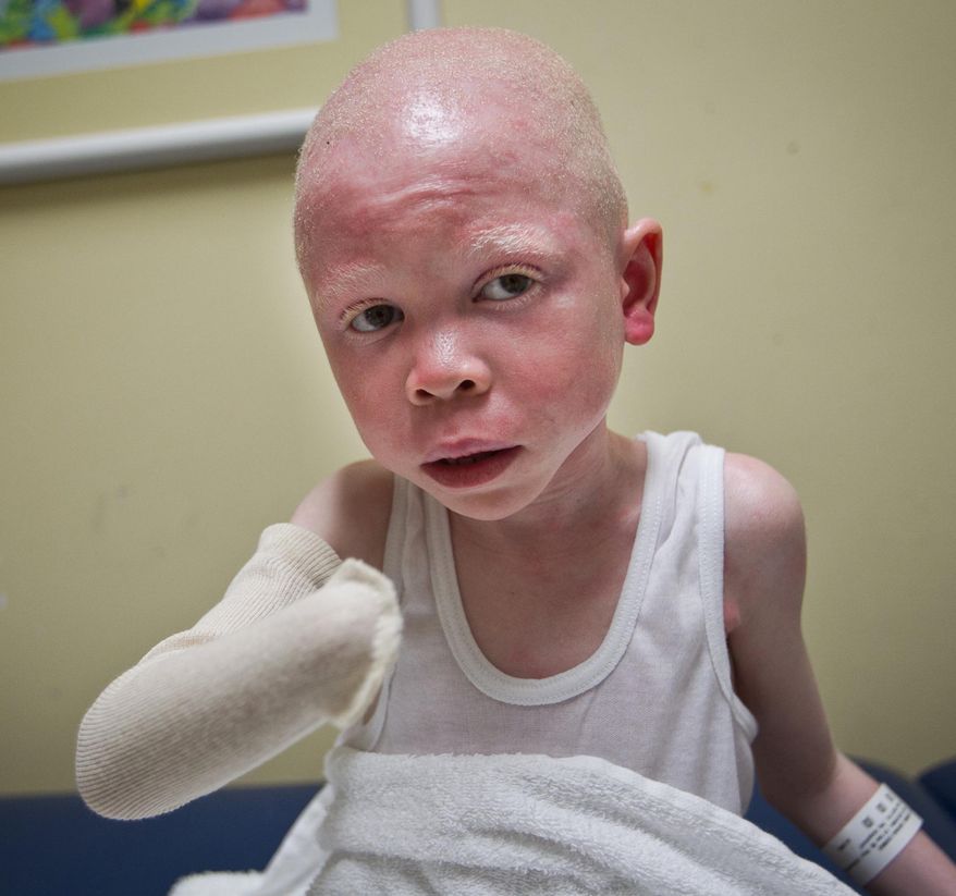 Baraka Cosmas Rusambo, 6 years old with albinism from Tanzania, is treated at Global Medical Relief Fund and Shriners Hospital for Children in Philadelphia on Wednesday, June 17, 2015. In March, assailants lopped off the right hand of Rusambo. Tanzanians subscribing to superstition see those with albino complexions as demons or ghosts with mystical powers whose body parts are cut off and used in witchcraft and potions. (Alejandro A. Alvarez/Philadelphia Daily News via AP) THE EVENING BULLETIN OUT, TV OUT; MAGS OUT; NO SALES
