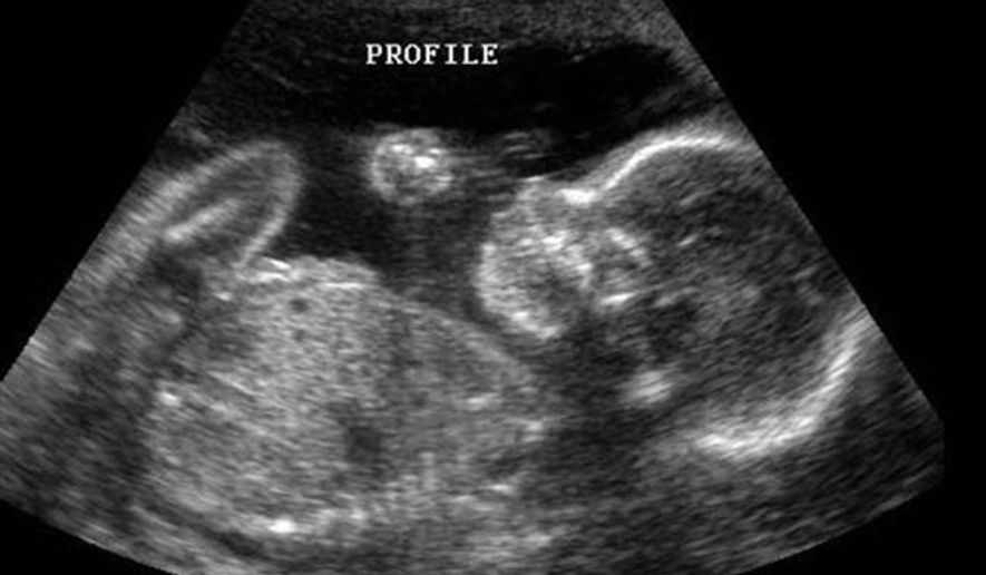 When is the best time to get a dating ultrasound