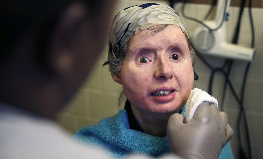 FILE - In this Feb. 20, 2015 file photo, Charla Nash smiles as her care worker washes her face at her apartment in Boston. The Connecticut woman who underwent a face transplant five years ago after being attacked by a chimpanzee is back in a Boston hospital after doctors discovered her body is rejecting the transplant. Nash says doctors have decided to end an experimental drug treatment and put her back on her original medication in the hopes of reversing the rejection.  (AP Photo/Charles Krupa, File)