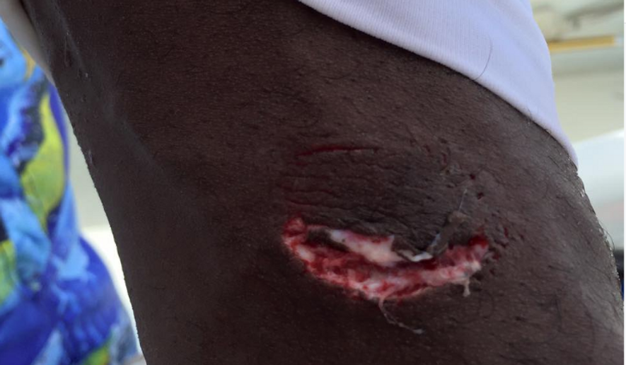 A picture of Warren Sapp's injury posted to social media.