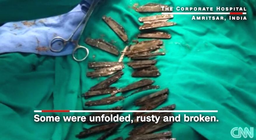 A man in Amritsar, India, swallowed over 40 knives over the course of two months because of an urge to consume metal. (CNN screenshot)