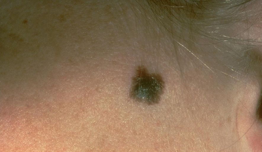 This photo provided by the American Academy of Dermatology shows a typical presentation of a suspicious mole that eventually was diagnosed as melanoma. (American Academy of Dermatology via AP) ** FILE **