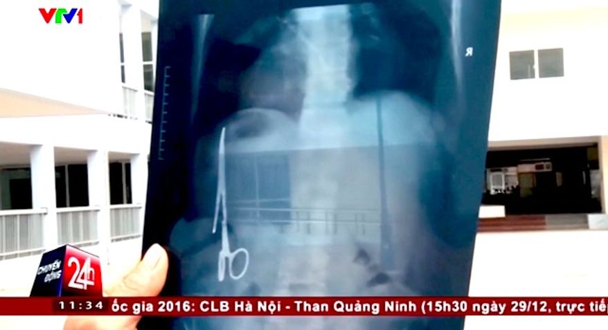 A 54-year old Vietnam man had six-inch scissors taken out of his stomach on Dec. 30 by doctors in Gang Thep Thai Nguyen hospital. The tool was left behind during a surgery that took place in 1998. (Vietnam News Agency screenshot)
