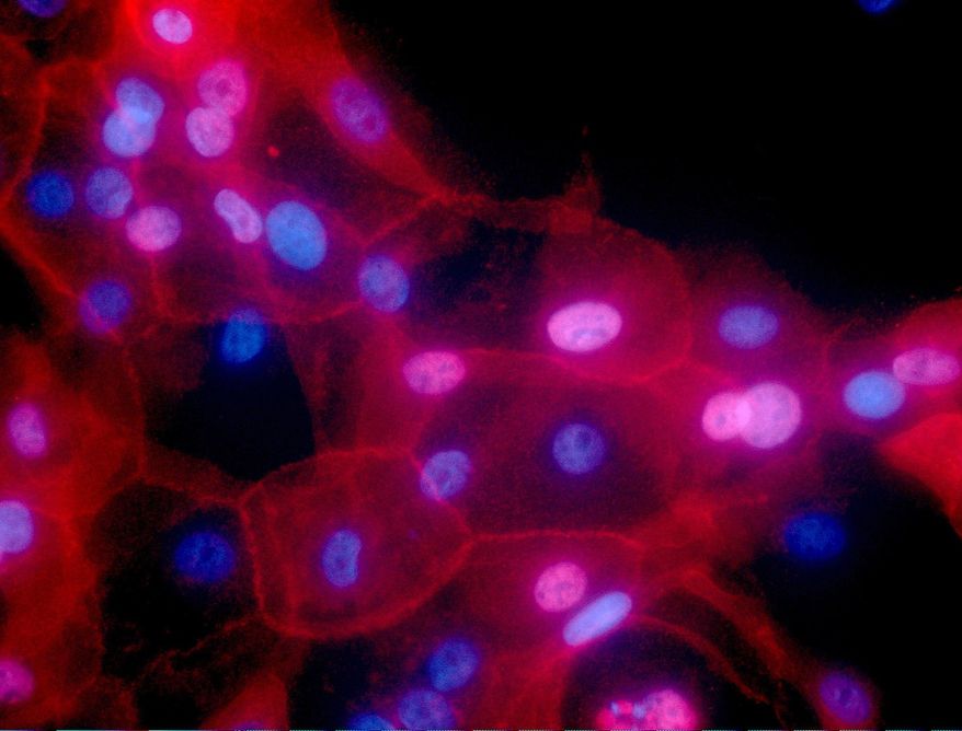 This undated fluorescence-colored microscope image made available by the National Institutes of Health in September 2016 shows a culture of human breast cancer cells. Environmental risks and heredity get the most blame for cancer, but new research released on Thursday, March 23, 2017, suggests random chance may play a bigger role than people realize: Healthy cells naturally make mistakes when they multiply, typos in your DNA that can leave new cells carrying cancer-prone genetic mutations. (Ewa Krawczyk/National Cancer Institute via AP) ** FILE **