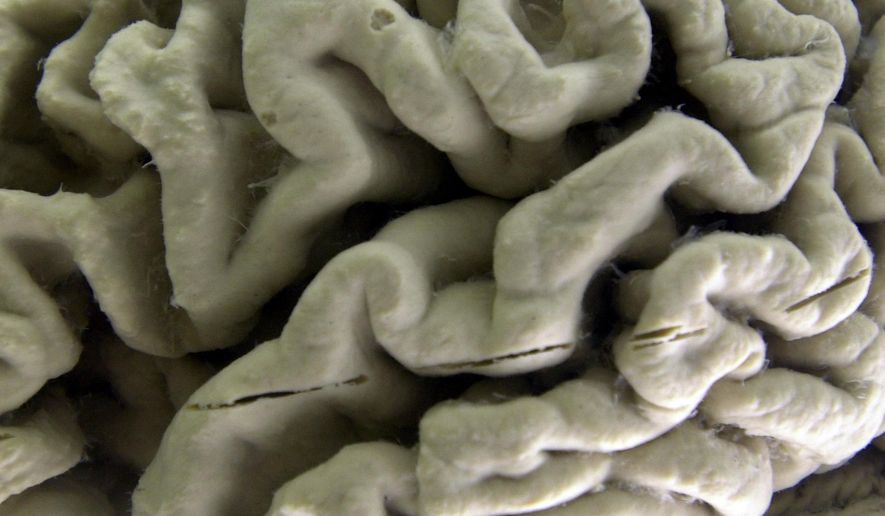 In this Oct. 7, 2003, file photo, a section of a human brain with Alzheimer&#39;s disease is on display at the Museum of Neuroanatomy at the University at Buffalo, in Buffalo, N.Y. (AP Photo/David Duprey, File)