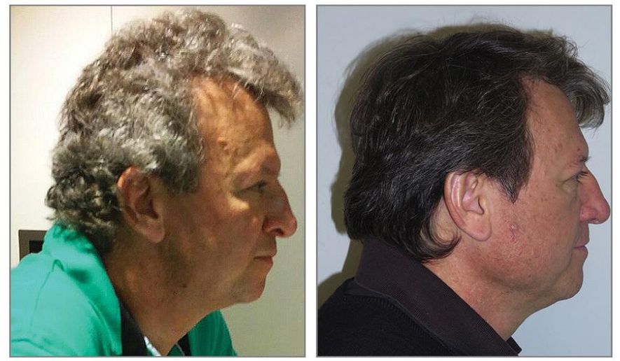 This undated combination of photos provided by the Journal of the American Medical Association in July 2017 shows a cancer patient with gray hair that unexpectedly turned dark while taking new immunotherapy drugs. Fourteen such cases were among 52 lung cancer patients being followed to see whether they developed bad side effects from the drugs - Keytruda, Opdivo and Tecentriq. (JAMA via AP)