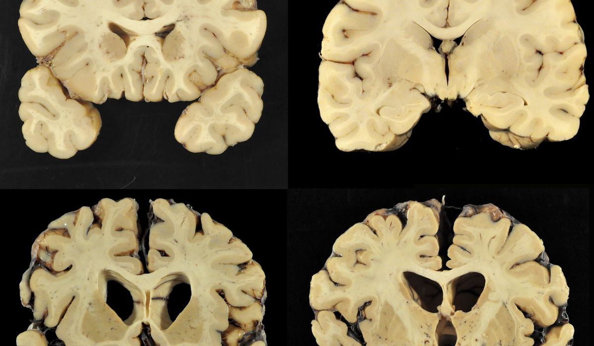 NextImg:What is Chronic Traumatic Encephalopathy or CTE?