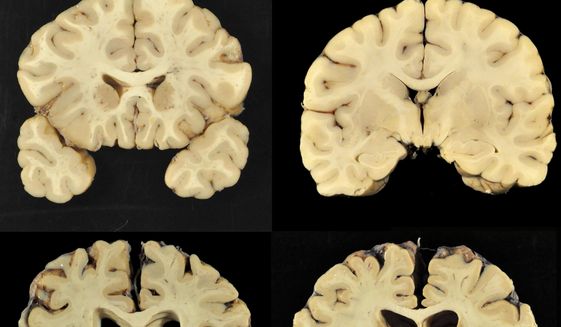 This combination of photos provided by Boston University shows sections from a normal brain, top, and from the brain of former University of Texas football player Greg Ploetz, bottom, in stage IV of chronic traumatic encephalopathy. According to a report released on Tuesday, July 25, 2017 by the Journal of the American Medical Association, research on the brains of 202 former football players has confirmed what many feared in life _ evidence of chronic traumatic encephalopathy, or CTE, a devastating disease in nearly all the samples, from athletes in the NFL, college and even high school. (Dr. Ann McKee/BU via AP) ** FILE **