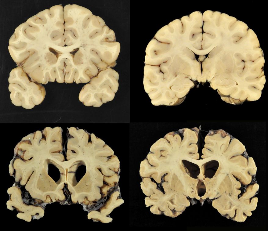 This combination of photos provided by Boston University shows sections from a normal brain, top, and from the brain of former University of Texas football player Greg Ploetz, bottom, in stage IV of chronic traumatic encephalopathy. According to a report released on Tuesday, July 25, 2017 by the Journal of the American Medical Association, research on the brains of 202 former football players has confirmed what many feared in life _ evidence of chronic traumatic encephalopathy, or CTE, a devastating disease in nearly all the samples, from athletes in the NFL, college and even high school. (Dr. Ann McKee/BU via AP) ** FILE **