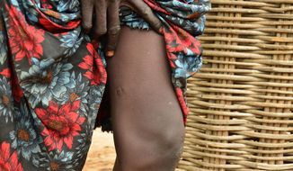 FILE - In this Oct. 4, 2017, photo, a woman points to two scars on her leg where two Guinea worms emerged, in Terekeka, South Sudan. South Sudan&#39;s health ministry says the country has gone 15 months without a single reported case of Guinea worm disease, suggesting a major victory for global health officials trying to eliminate the debilitating affliction.  (AP Photo/Mariah Quesada, File)