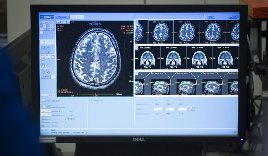 This March 23, 2017, file photo provided by the Sunnybrook Health Sciences Centre shows brain scans of patient Rick Karr as staff members treat him at the facility in Toronto, Canada. Karr was the first Alzheimer's patient treated with focused ultrasound to open the blood-brain barrier. Scientists are using ultrasound waves to temporarily jiggle an opening in the brain’s protective shield, in hopes the technique one day might help drugs for Alzheimer’s, brain tumors and other diseases better reach their target. (Kevin Van Paassen/Sunnybrook Health Sciences Centre via AP) ** FILE **