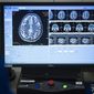This March 23, 2017, file photo provided by the Sunnybrook Health Sciences Centre shows brain scans of patient Rick Karr as staff members treat him at the facility in Toronto, Canada. Karr was the first Alzheimer&#39;s patient treated with focused ultrasound to open the blood-brain barrier. Scientists are using ultrasound waves to temporarily jiggle an opening in the brain’s protective shield, in hopes the technique one day might help drugs for Alzheimer’s, brain tumors and other diseases better reach their target. (Kevin Van Paassen/Sunnybrook Health Sciences Centre via AP) ** FILE **