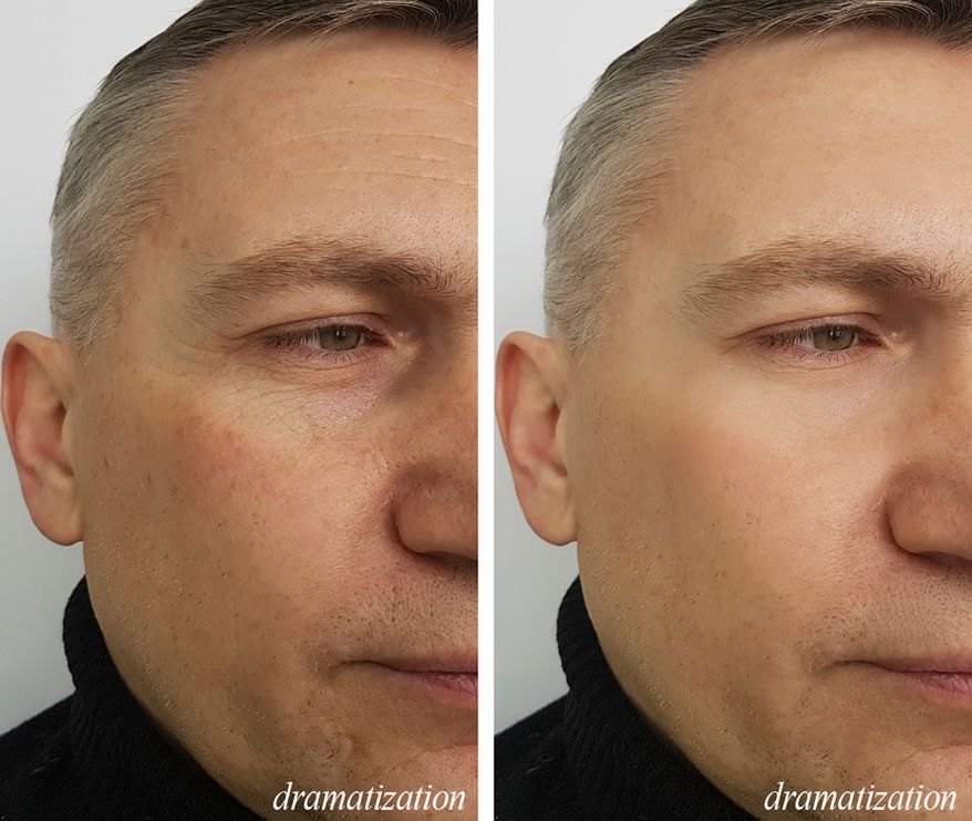 Conservative Men Don’t Get Facelifts. Learn How This 58-Year Old Gave His Aging Skin A Tighter, Younger Look Without Surgery (SPONSORED)