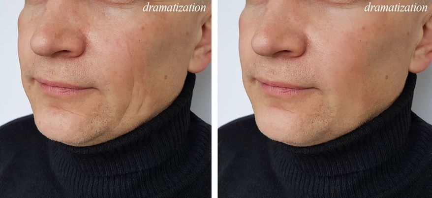 Conservative Men Don’t Get Facelifts. Learn How This 58-Year Old Gave His Aging Skin A Tighter, Younger Look Without Surgery (SPONSORED)