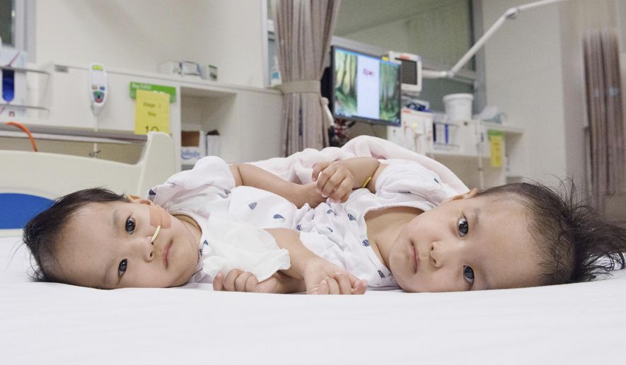 This photo provided by RCH Melbourne Creative Studio, shows the 15-month-old girls before surgery at the Royal Children&#39;s Hospital  Melbourne, Australia Friday, Nov. 9, 2018. Surgeons in Australia have begun separating the conjoined twins from Bhutan in a delicate operation expected to last most of the day. (RCH Melbourne Creative Studio via AP)