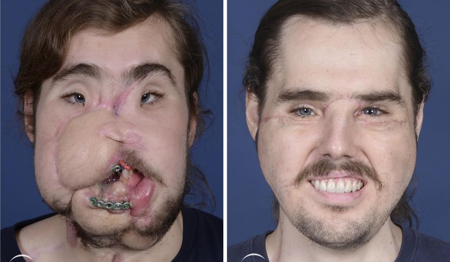 These photos provided by NYU Langone Health, show patient Cameron Underwood, left, on March 15, 2017, and right, on Oct. 17, 2018, following his face transplant. The northern California man whose suicide attempt left his face horribly disfigured had successful facial transplant surgery in early 2018. (Mary Spano/NYU Langone Health via AP)