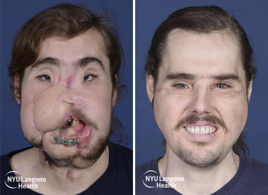 These photos provided by NYU Langone Health, show patient Cameron Underwood, left, on March 15, 2017, and right, on Oct. 17, 2018, following his face transplant. The northern California man whose suicide attempt left his face horribly disfigured had successful facial transplant surgery in early 2018. (Mary Spano/NYU Langone Health via AP)