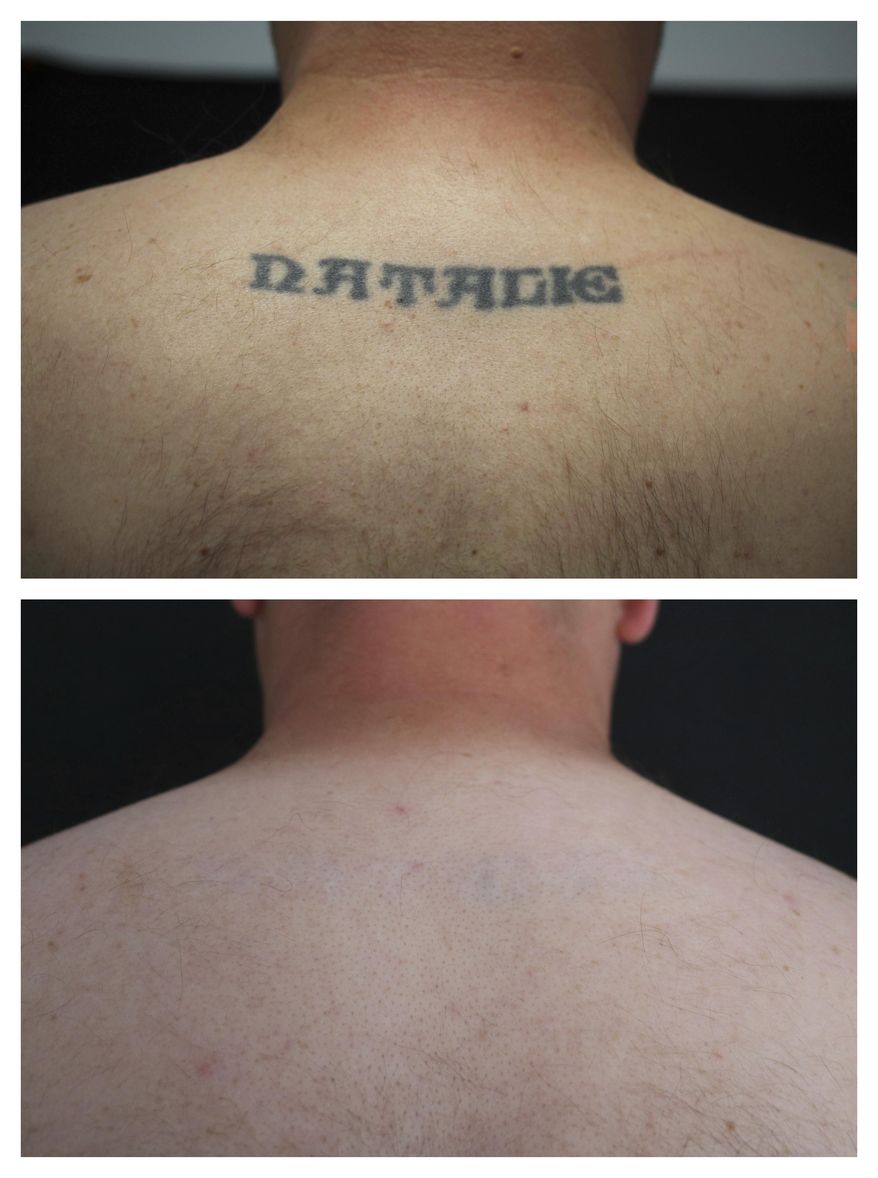 This combination of undated photos provided by Dr. Paul Friedman in July 2019 shows the back of patient Ryan Tucker before and after a series of laser tattoo removal procedures in Houston. Friedman, a spokesman for the American Society for Dermatologic Surgery, says people of all ages are seeking removals, but he’s seen an increase among millennials. The medical group estimates its members performed 85,000 tattoo removals in 2017, the latest data available, but that doesn’t include other medical workers remove them. (Dr. Paul Friedman via AP)