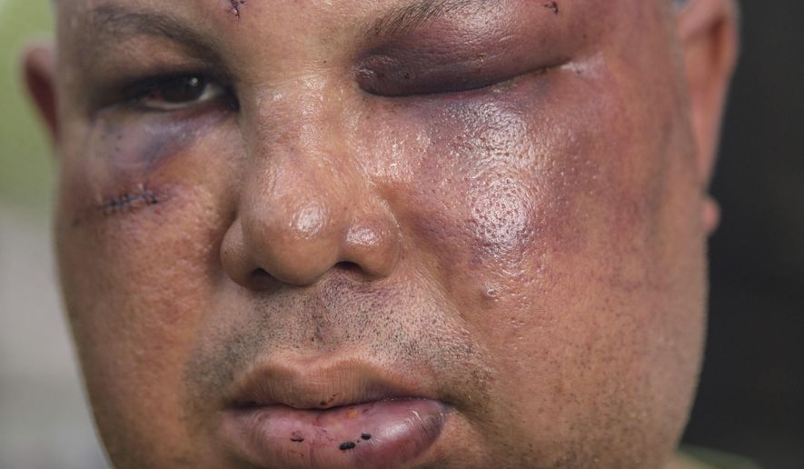 This July 25, 2018, photo shows beating victim Jorge Gomez. Gomez has filed a lawsuit against the city of New Orleans and two former police officers accused of beating him and racially taunting him a day earlier. One of the officers pleaded guilty Wednesday, Aug. 7, 2019, to disturbing the peace in a plea deal. (Matthew Hinton/The Times-Picayune/The New Orleans Advocate via AP)