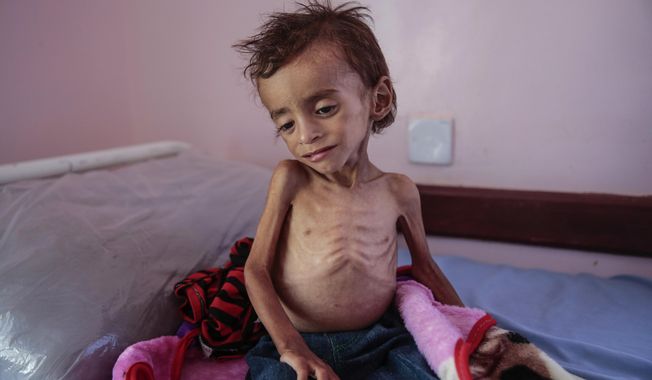 In this Oct. 1, 2018 file photo, a malnourished boy sits on a hospital bed at the Aslam Health Center, Hajjah, Yemen. Houthi rebels in Yemen have blocked half of the United Nations’ aid delivery programs in the war-torn country — a strong-arm tactic to force the agency to give them greater control over the massive humanitarian campaign, along with a cut of billions of dollars in foreign assistance, according to aid officials and internal documents obtained by The Associated Press. (AP Photo/Hani Mohammed, File)