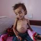 In this Oct. 1, 2018 file photo, a malnourished boy sits on a hospital bed at the Aslam Health Center, Hajjah, Yemen. Houthi rebels in Yemen have blocked half of the United Nations’ aid delivery programs in the war-torn country — a strong-arm tactic to force the agency to give them greater control over the massive humanitarian campaign, along with a cut of billions of dollars in foreign assistance, according to aid officials and internal documents obtained by The Associated Press. (AP Photo/Hani Mohammed, File)