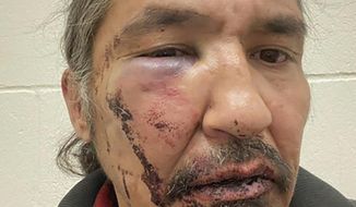 This March 10, 2020 photo provided by Chief Adam, shows the bloodied face of Athabasca Chipewyan First Nation Chief Allan Adam after a confrontation with Royal Canadian Mounted Police. Canadian Prime Minister Justin Trudeau says police dashcam video of the violent arrest of the Canadian aboriginal chief is shocking and not an isolated incident. The arrest has received attention in Canada as a backlash against racism grows in the wake of the death of George Floyd, a black man who died after a white Minneapolis police officer pressed a knee to his neck.  (Allan Adam/The Canadian Press via AP)