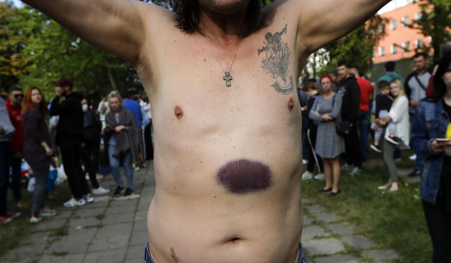 A man shows bruises he says were left by police beating after being released from a detention center where protesters were detained during a mass rally following the presidential election in Minsk, Belarus, Friday, Aug. 14, 2020. Belarusian authorities have released more than 1,000 people detained during a violent police crackdown on protests and many talked about brutal beatings and other abuse by police. (AP Photo/Sergei Grits)